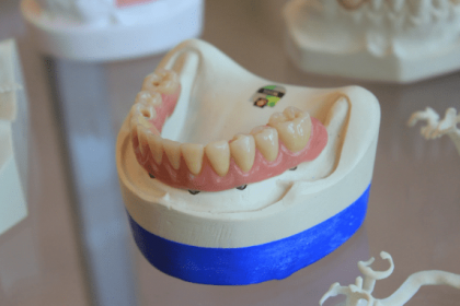 do-acrylic-partial-dentures-help-maintain-jawbone-health?