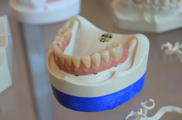do-acrylic-partial-dentures-help-maintain-jawbone-health?